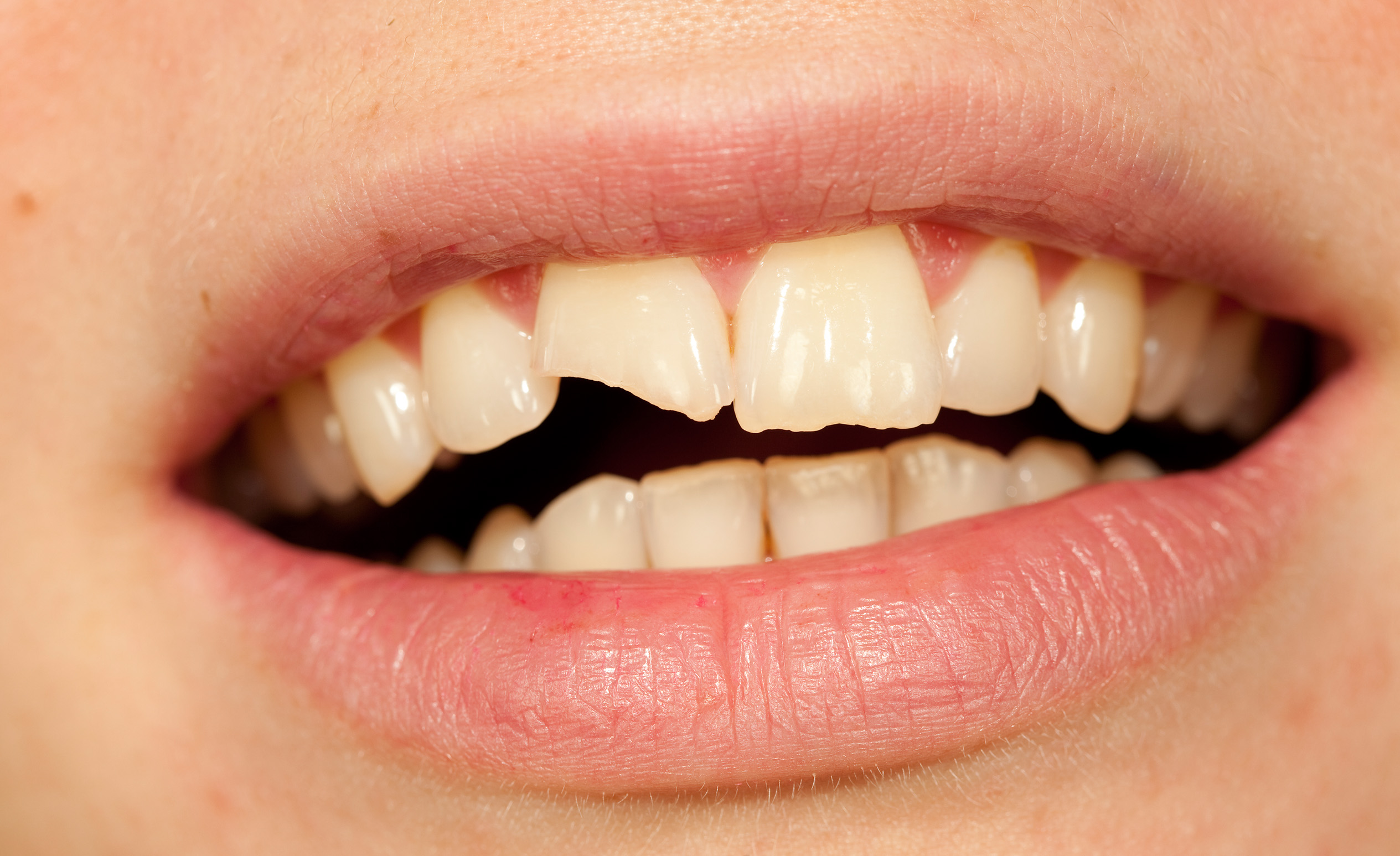 Mosoly letört fog pótlása előtt.