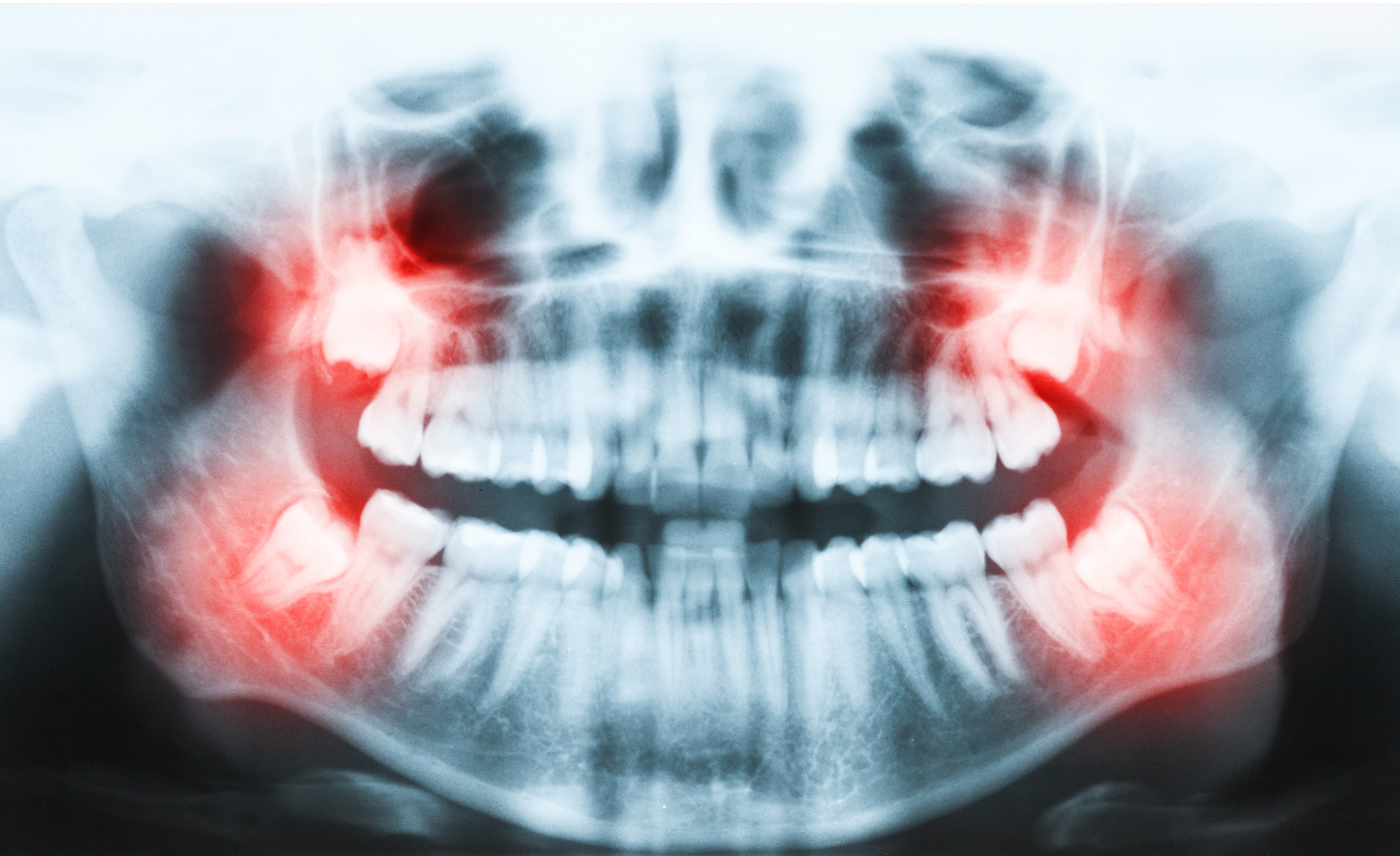 Fogászati röntgen felvétel, bölcsességfog műtét előtt.