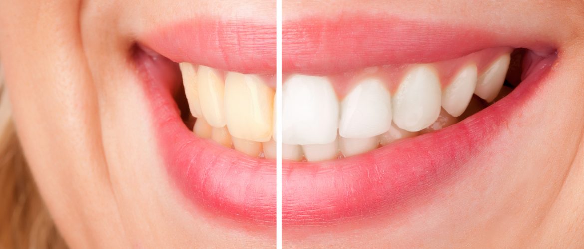 Női mosoly fogfehérítés előtt és után.