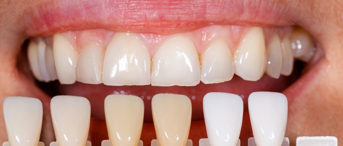 Fogfehérítés után megnéznik az árnyalatát a fognak.