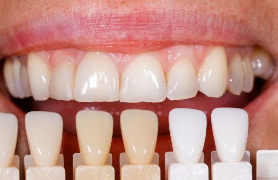 Fogfehérítés után megnéznik az árnyalatát a fognak.