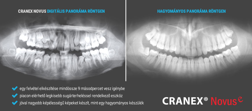 Kép amin egy digitális és egy hagyományos panoráma röntgen felvétel.