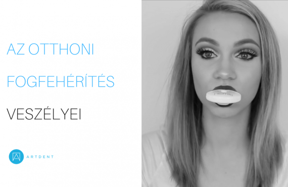 Egy fiatal nő otthoni fogfehérítés közben. A szályában egy fogfehérítésre alkalmas eszköz.