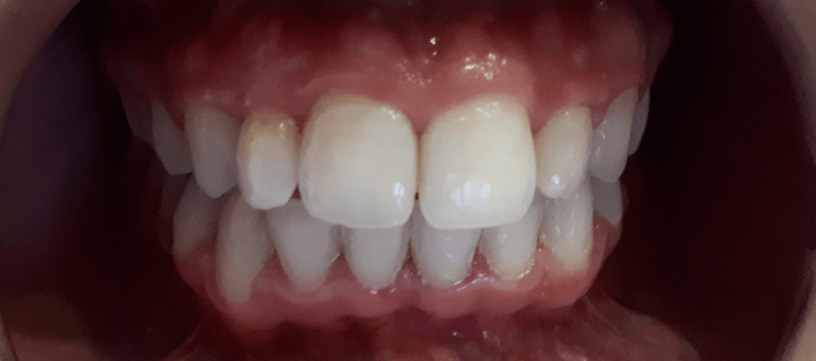 Esetbemutatás: fogszabályozás keresztharapás - utána