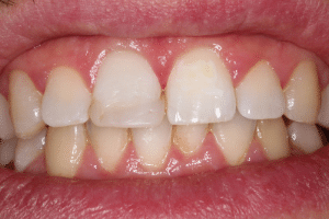 Ardent esetbemutatás porcelánhéj előtte cover kép