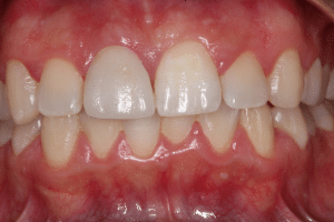 Ardent esetbemutatás porcelánhéj utána cover kép