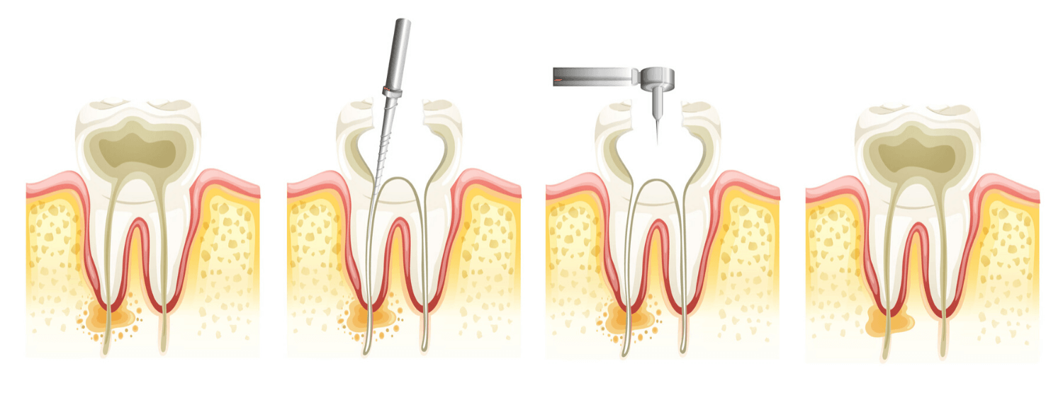 Gyökérkezelés négy lépéséről egy infografika.