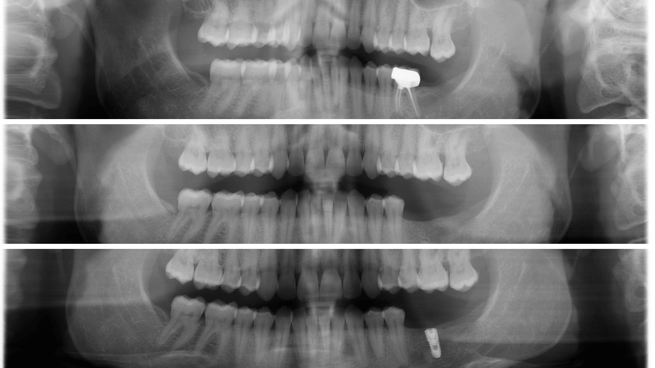 Foghúzás után fogbeültetés - egyszerre lehetséges! Röntgenfelvétel az Artdent Fogászatnál