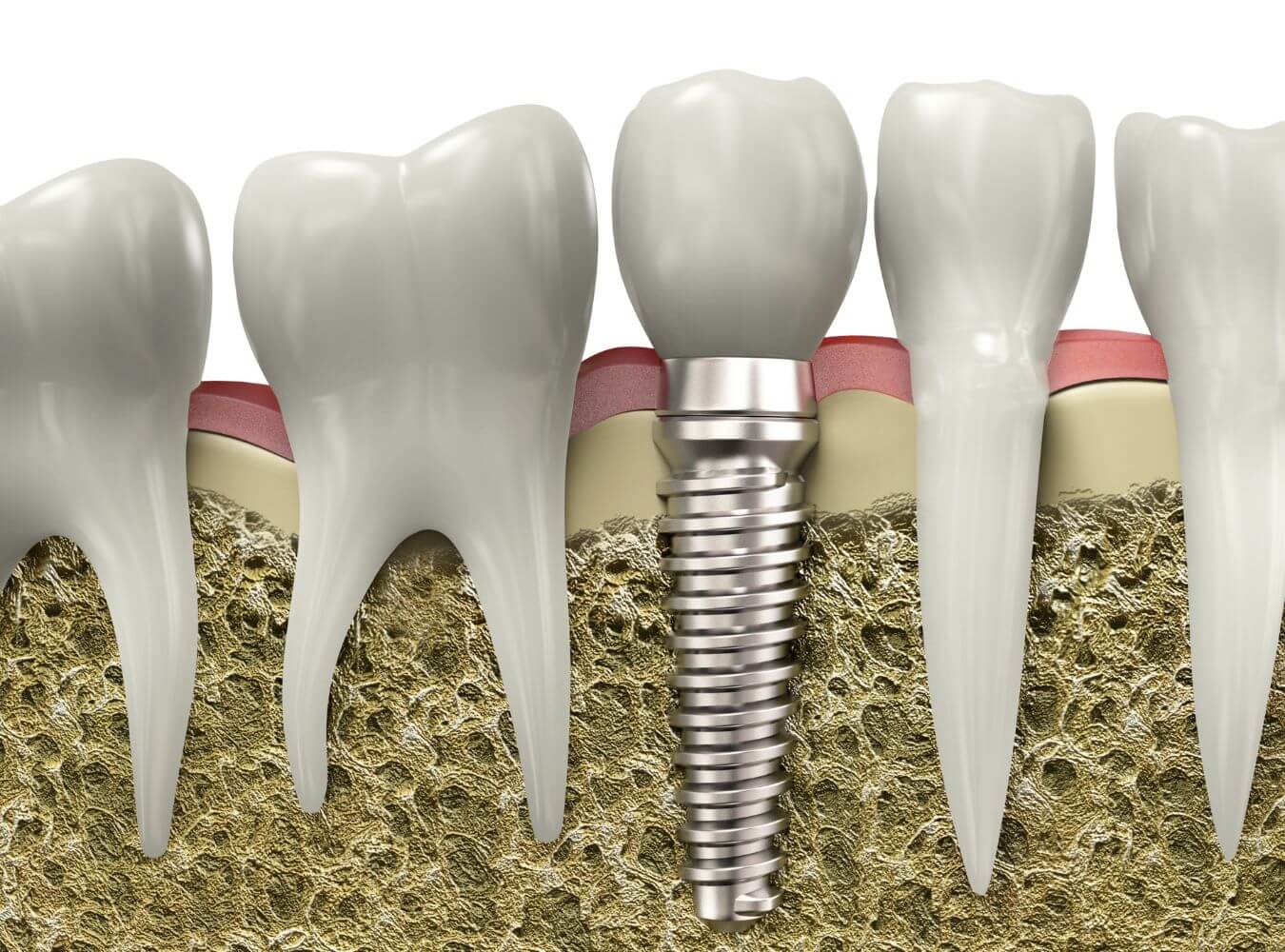 Fogimplantátum csavart(fogbeültetést) ábrázoló 3D grafika.