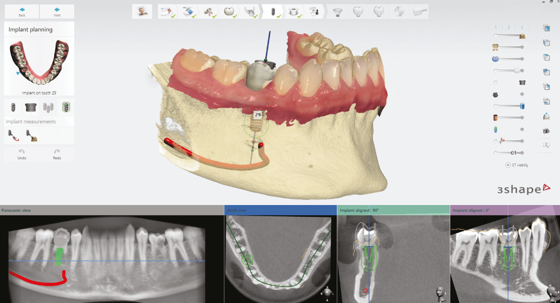 Intraorális szkenner, digitális lenyomat egy monitoron.